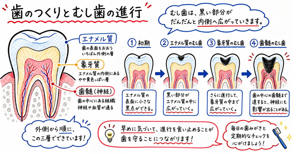 痛くないのに奥歯が黒いのはなぜ？自覚症状なしでむし歯が進行するメカニズム