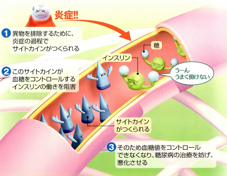 歯周病と糖尿病について その3｜歯の豆知識｜いちば歯科｜大阪市鶴見区の歯医者・矯正歯科・インプラント治療